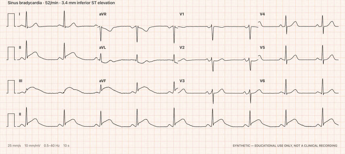 ECG Builder — a 12-lead sheet exported at print scale